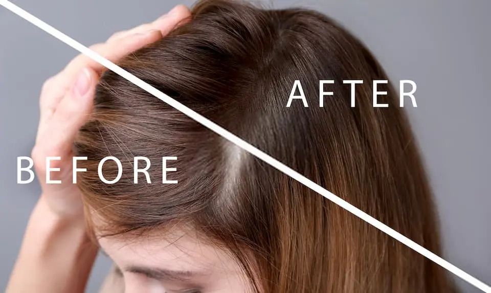 Artificial hair transplant: Cost and advantages - Turkiya Holidays Artificial hair transplant: Cost and advantages - Turkiya Holidays